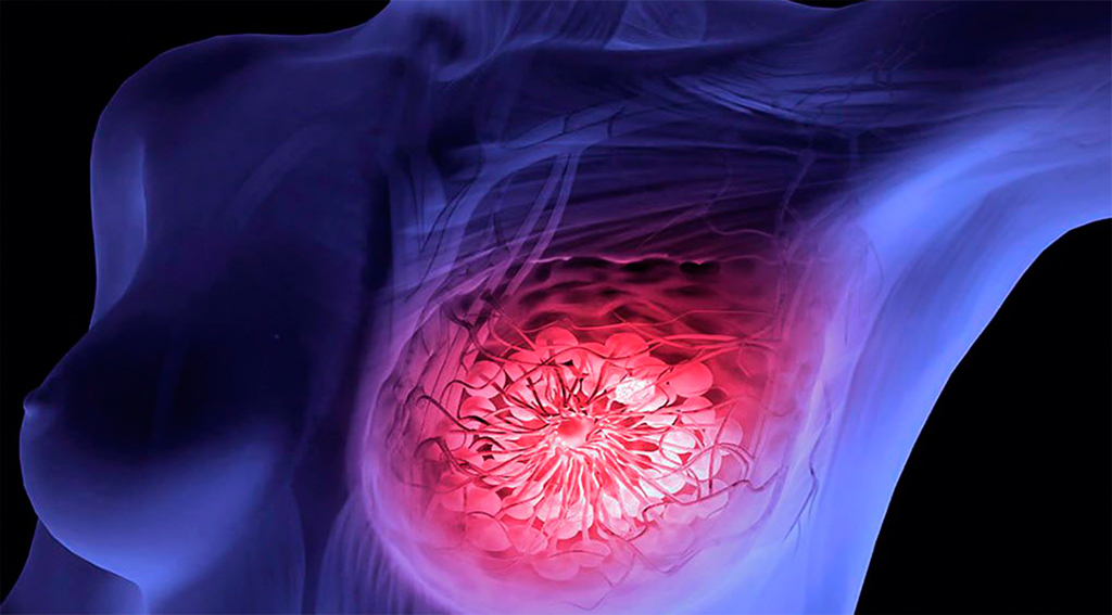 19 de Octubre: Día mundial de la lucha contra el cáncer de mama